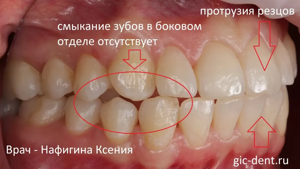 Отсутствие смыкания боковых зубов и протрузия резцов вид справа. Лечащий врач - ортодонт НИЦ Нафигина Ксения